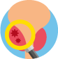 Prostate Biopsy