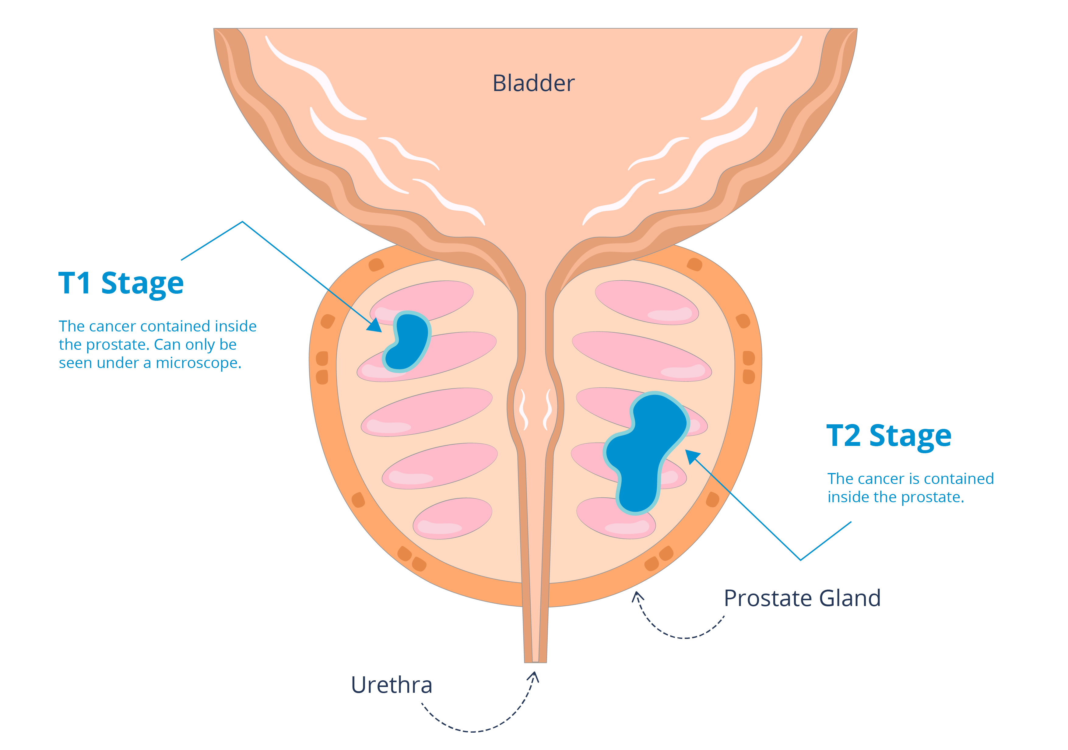 drawing of T1 and T2 confined within the prostate