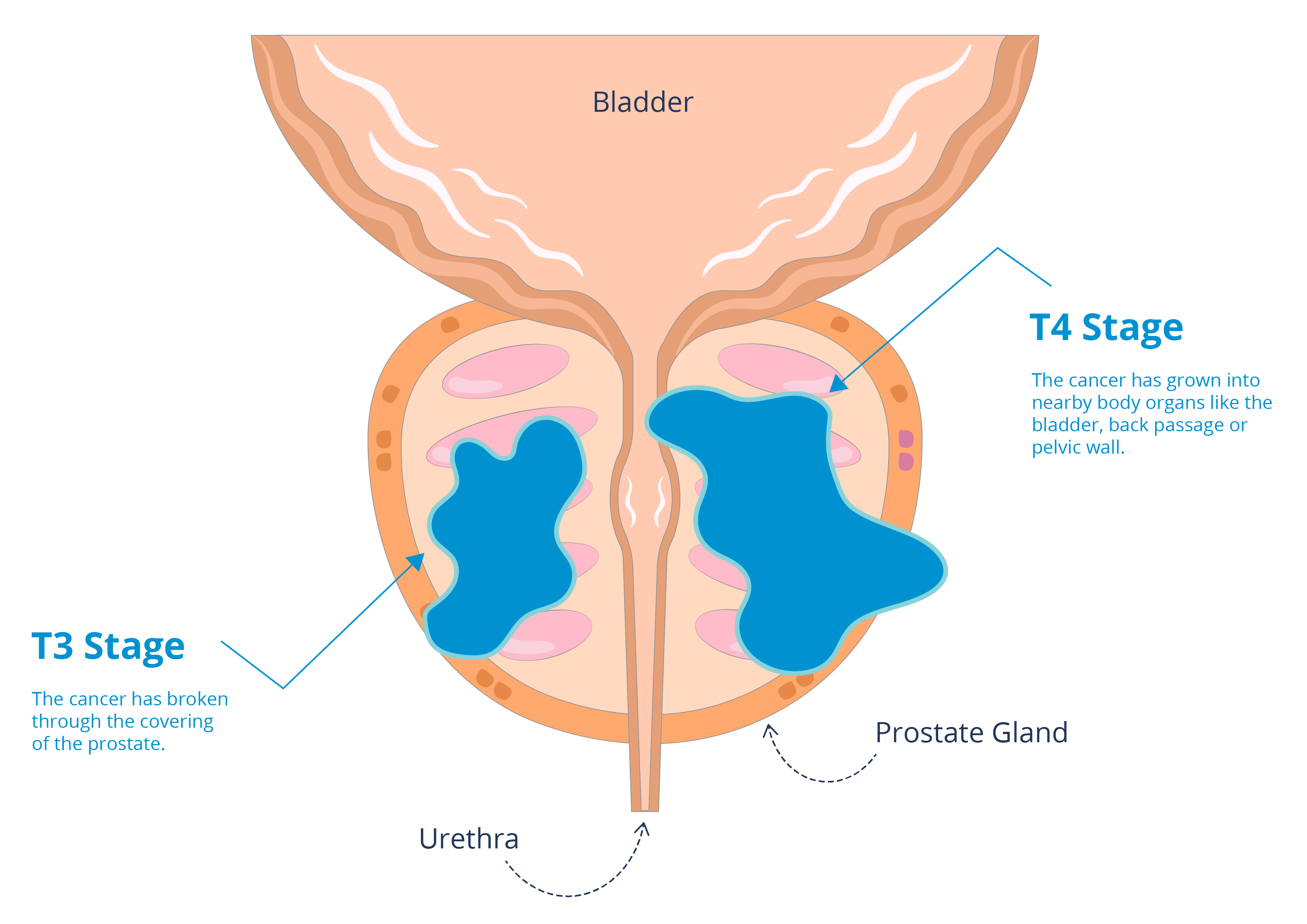 Diagram of T3 and T4 stages 