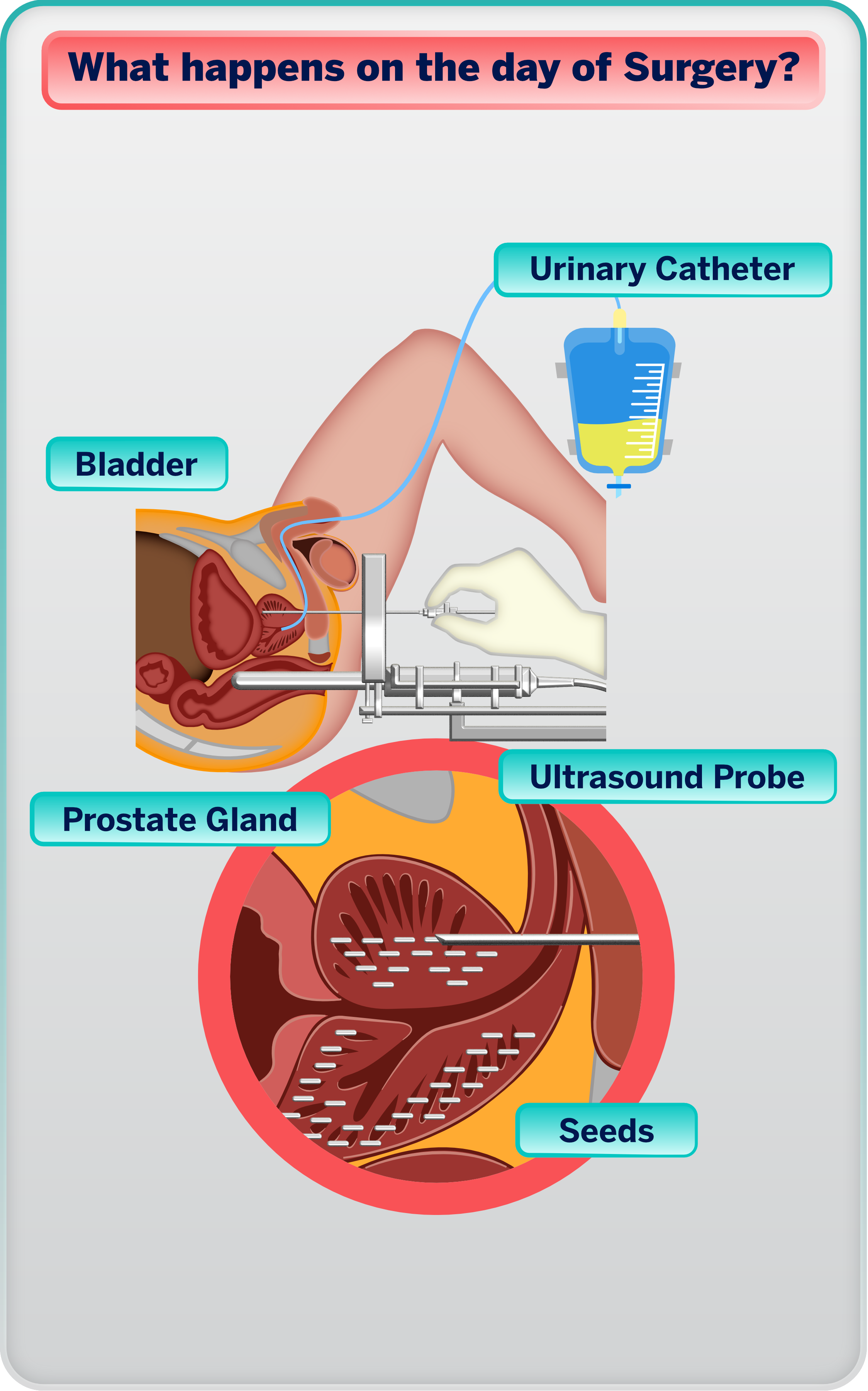 Showing placement of seeds in prostate and urinary catheter