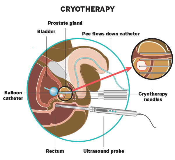 Image showing the cryotherapy procedure