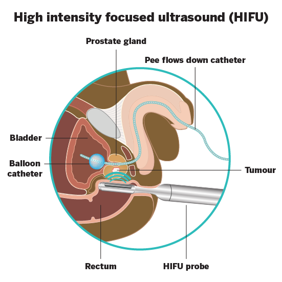 Image showing the HIFU procedure