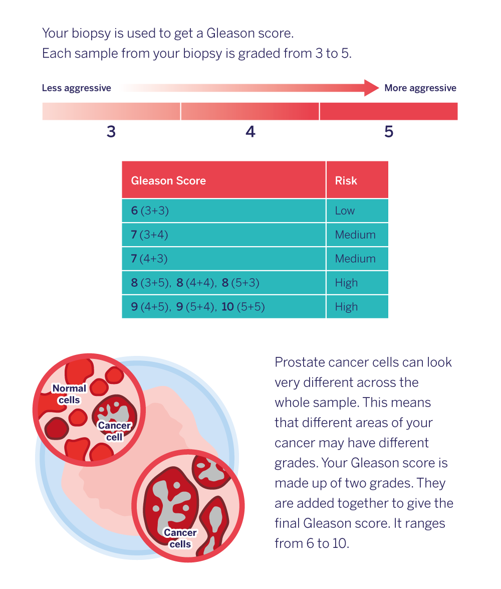 Gleason score table and cancer cells