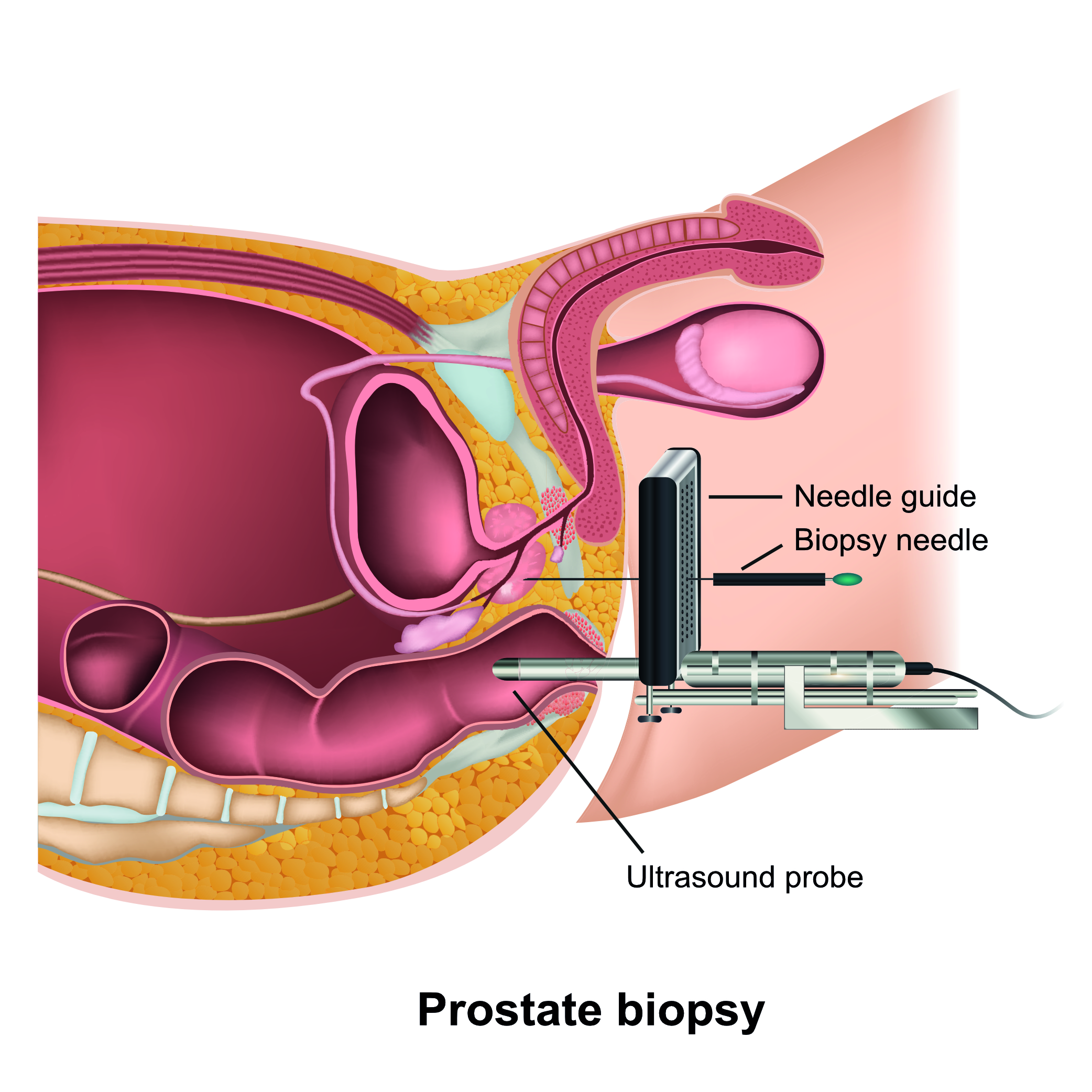 illustration showing transperineal prostate biospy