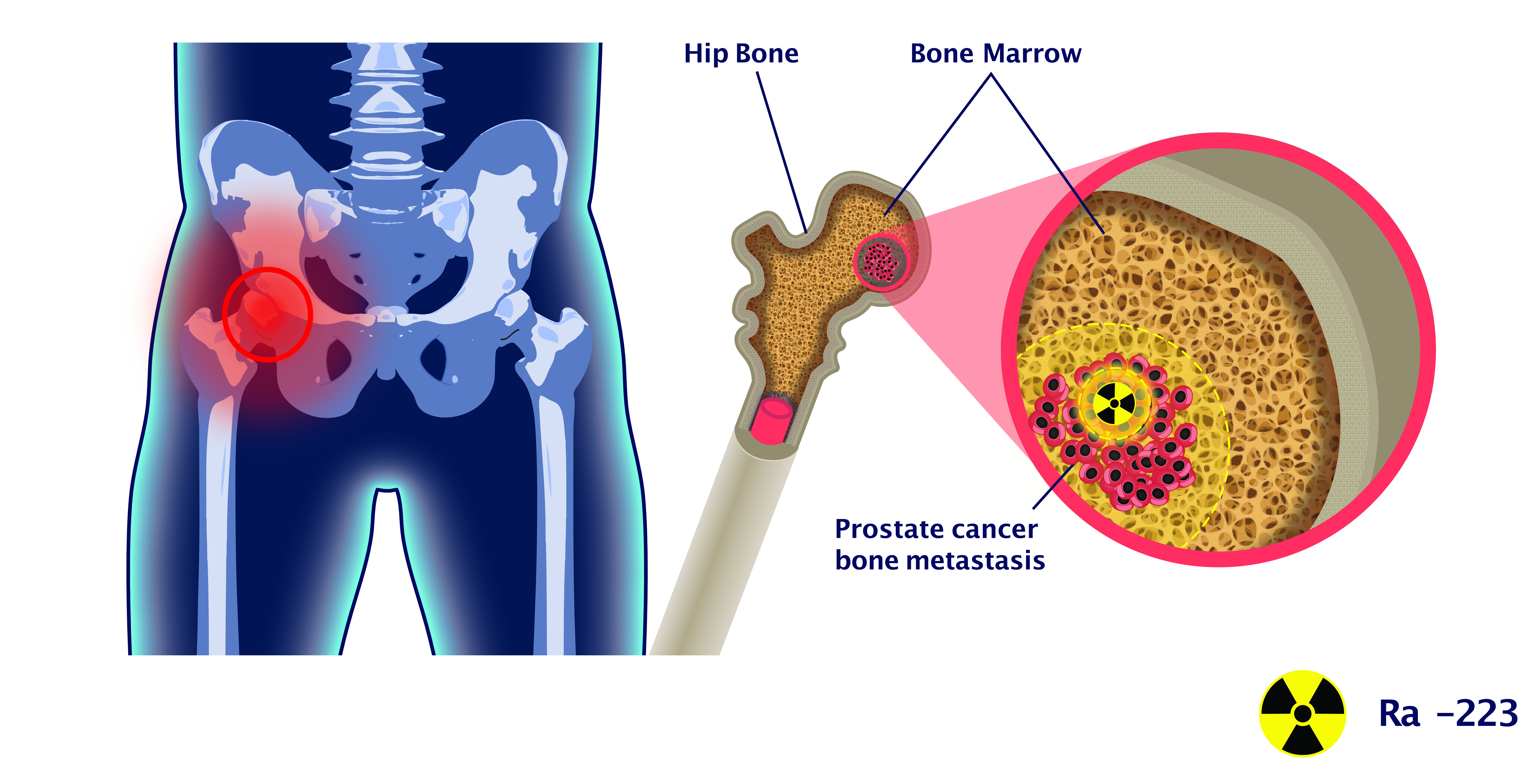 Radium 223 in the body