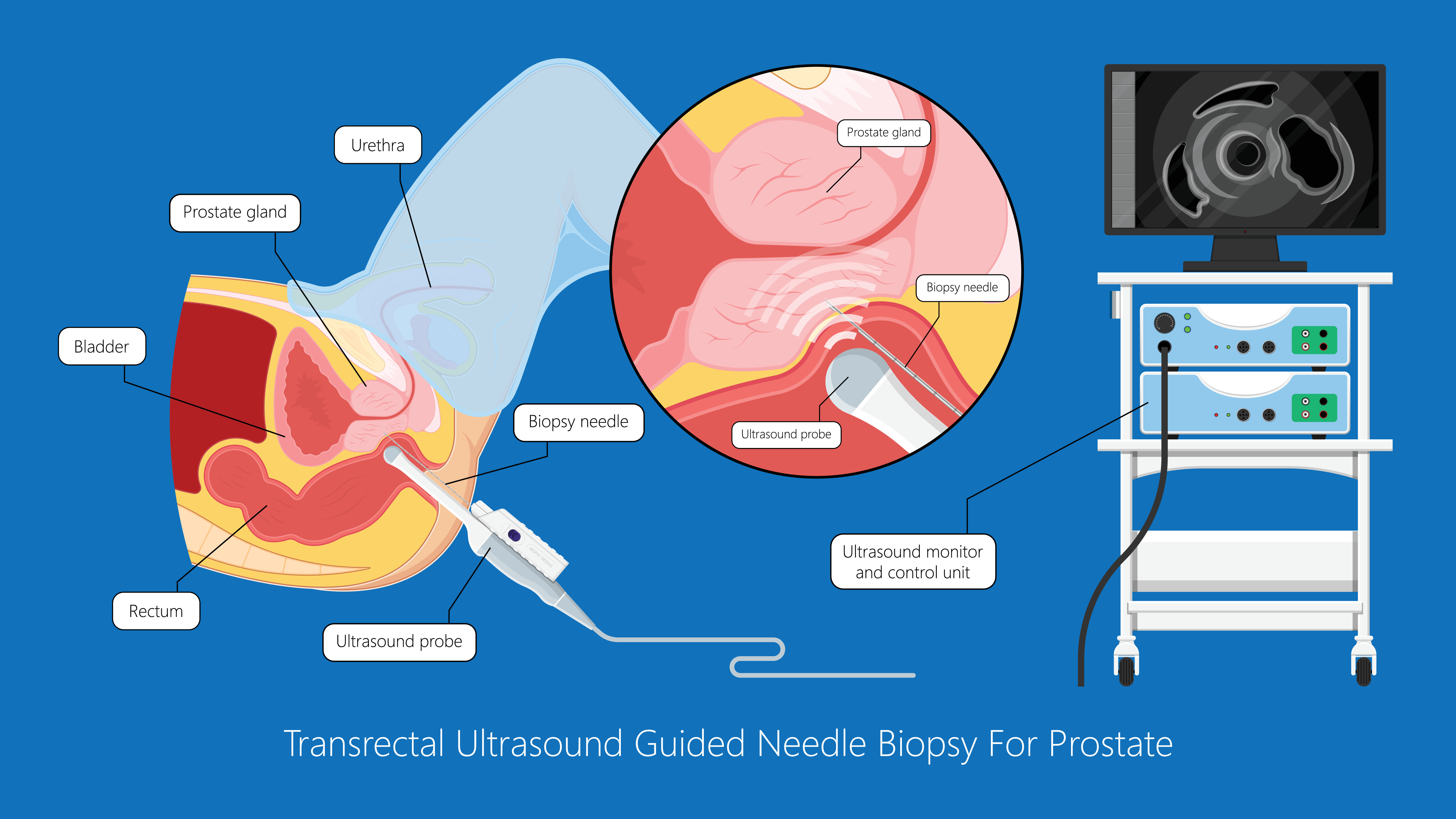 prostate biopsy