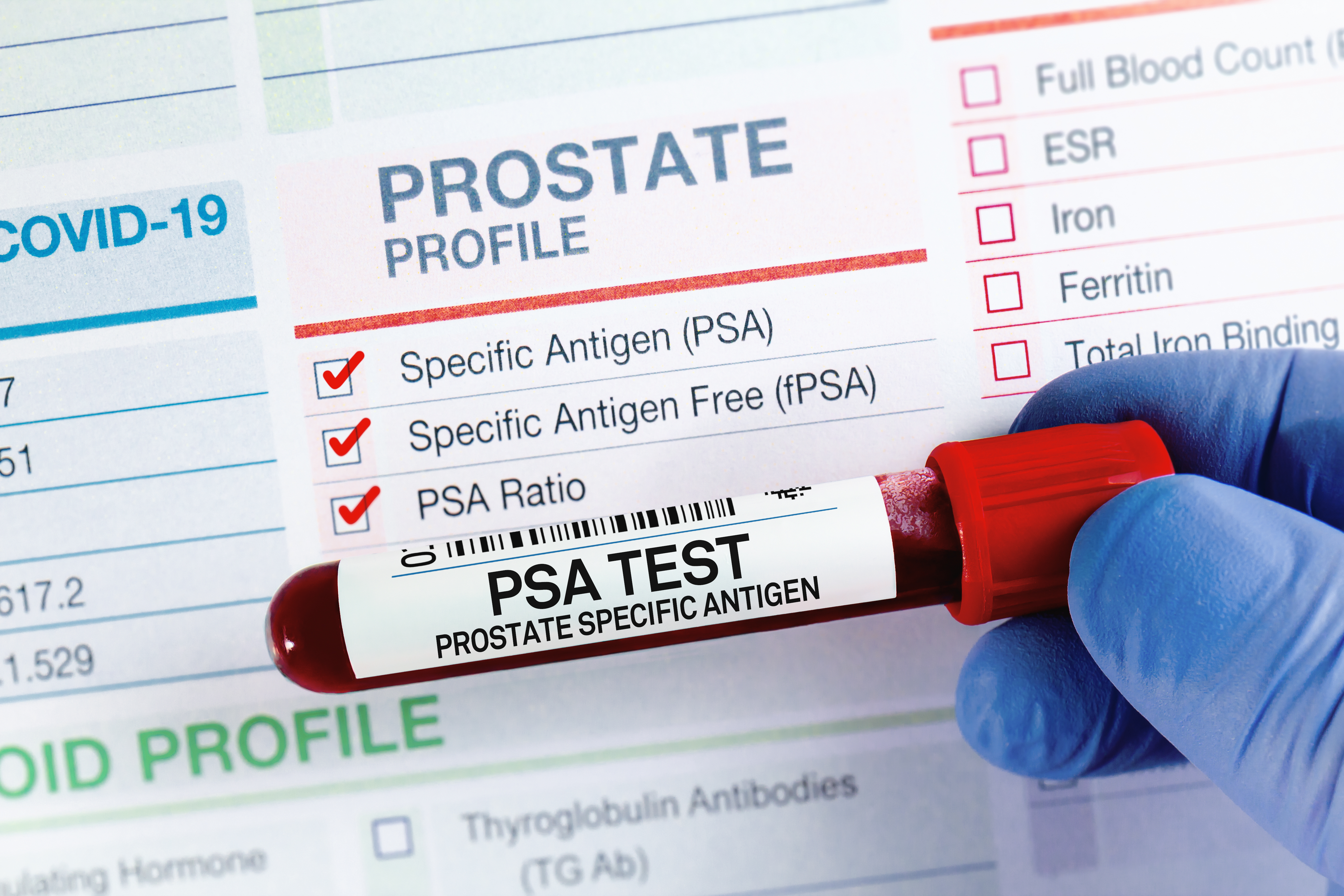 Photo of test tube with blood labelled PSA test