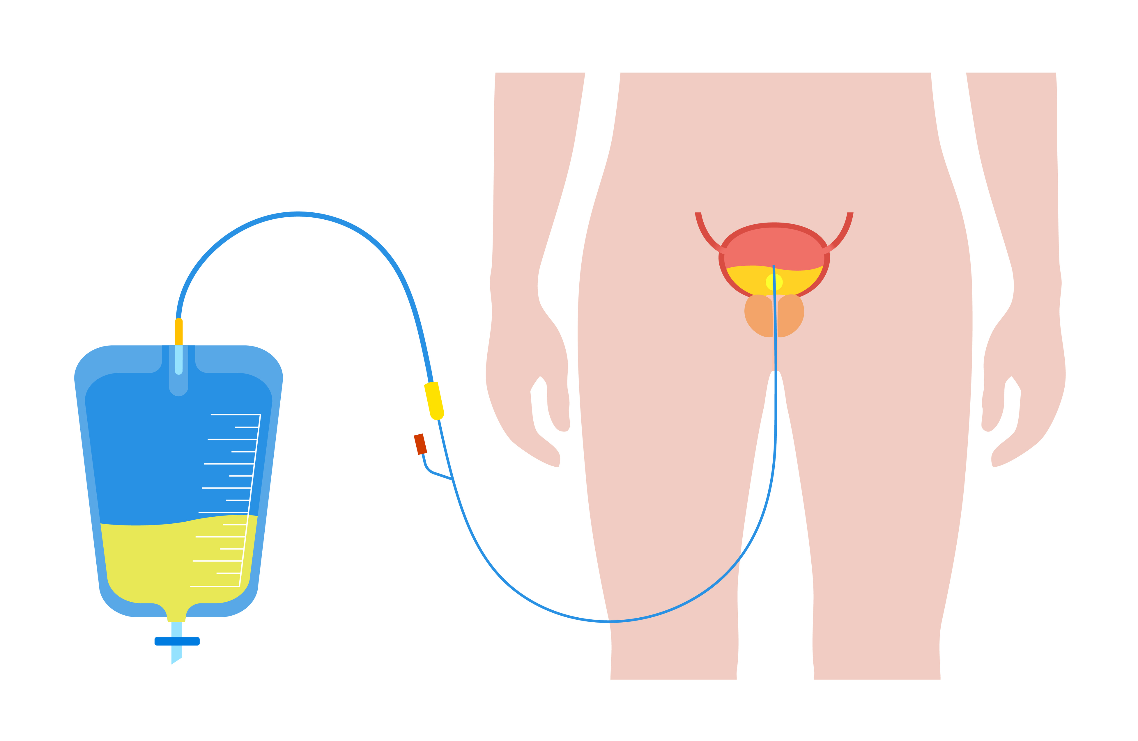 Diagram showing urinary catheter in bladder