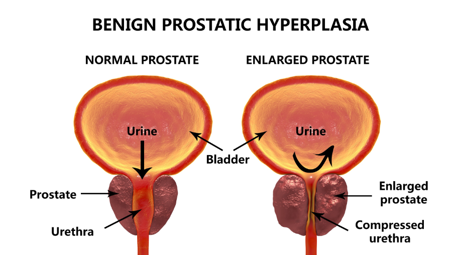 Benign Prostatic Hyperplasia