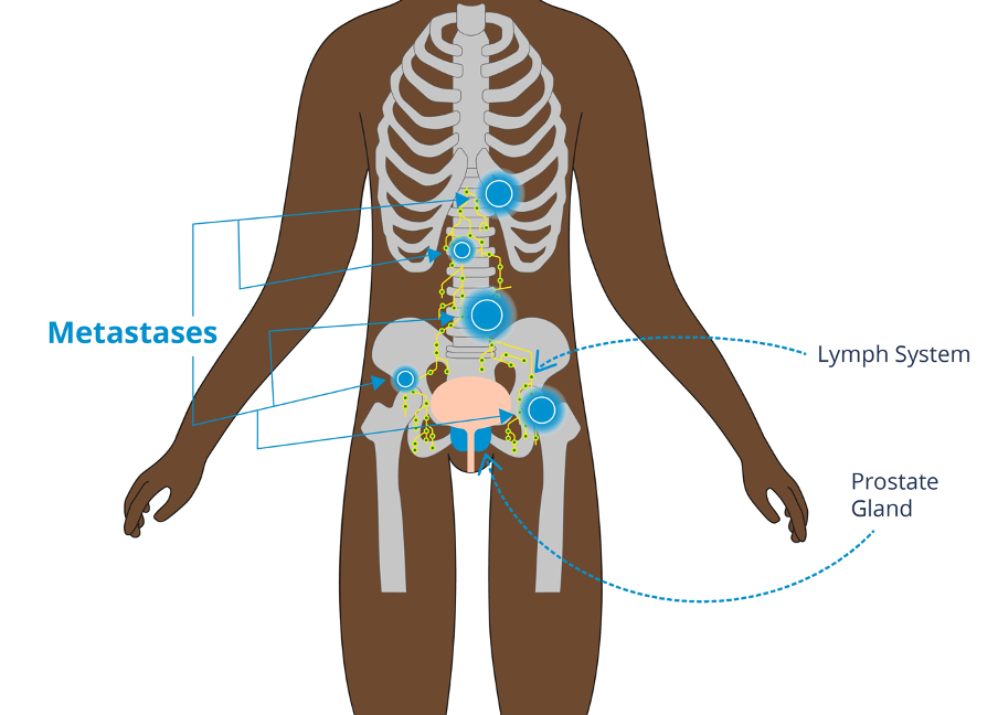 black man with metastases around the body