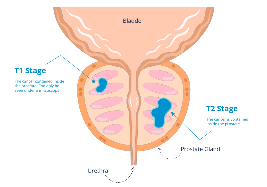 T1 and T2 stage prostate cancer