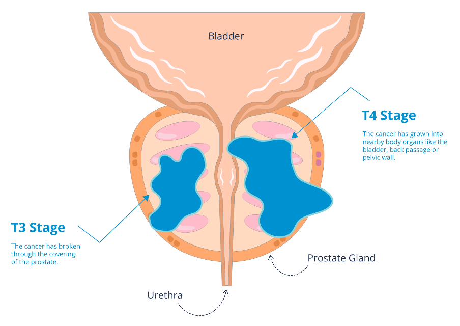 T3 and T4 stage prostate cancer