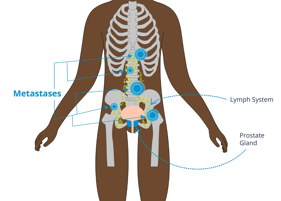 Metastases