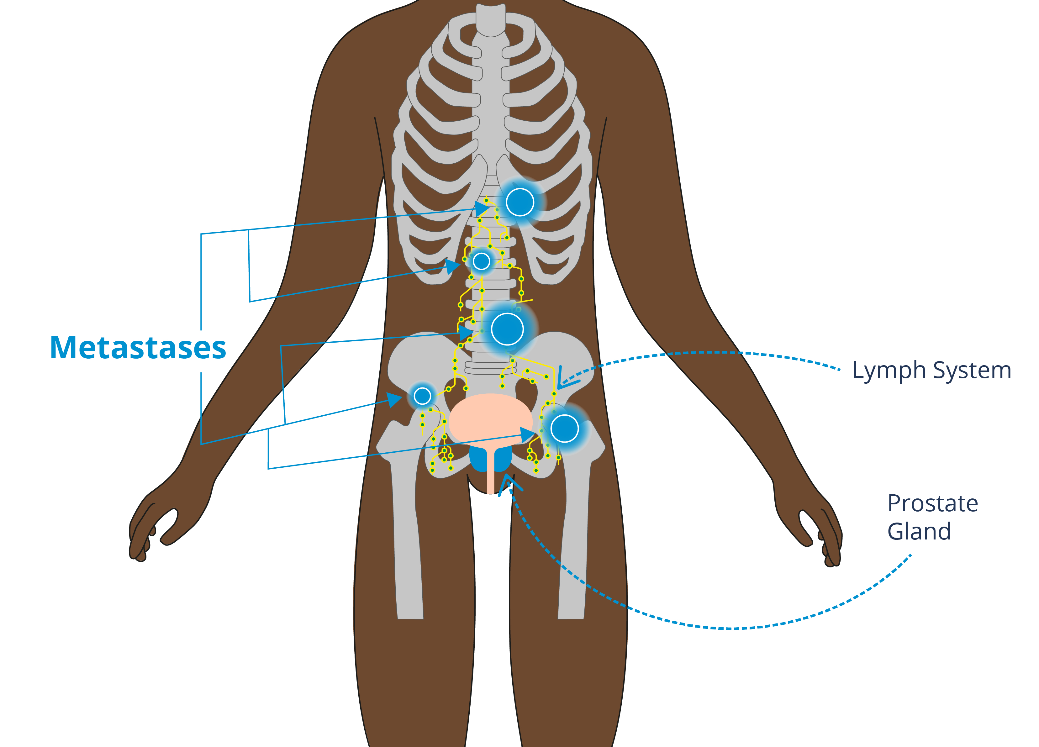 Brown body showing metastases in the bones and lymph system