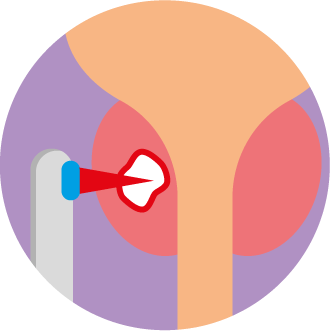 Treatment focused on one area of cancer on the prostate